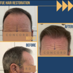 Hair Restoration,
