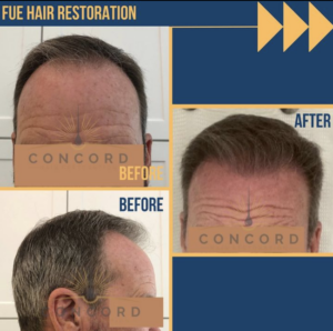 Hair Restoration,